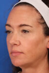 Blepharoplasty case #5591