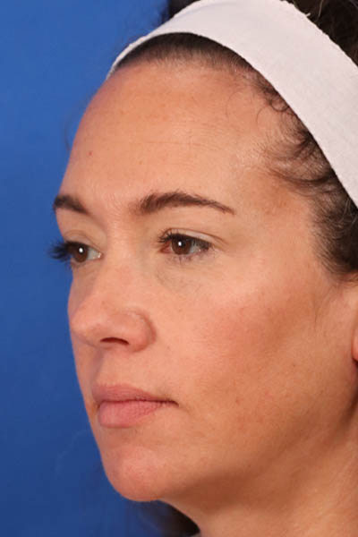 Blepharoplasty case #5591