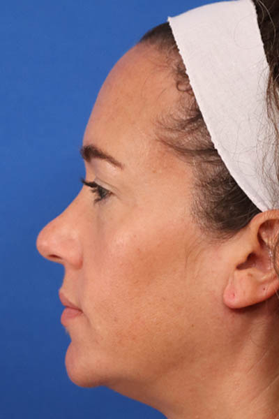 Blepharoplasty case #5591