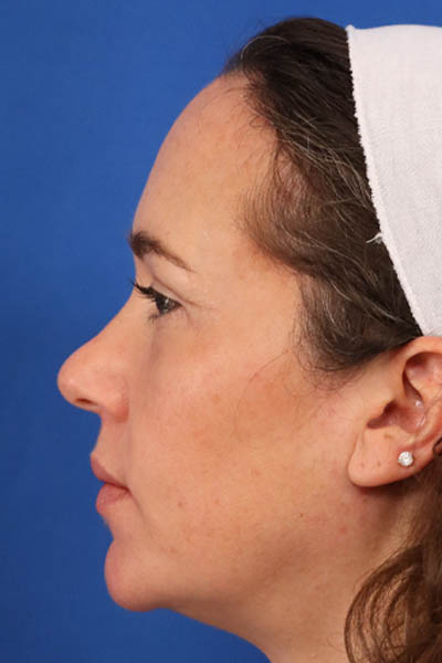 Blepharoplasty case #5591
