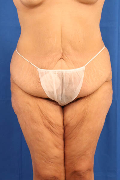 Thigh Lift case #5532