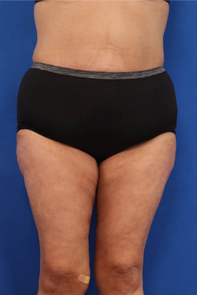 Thigh Lift case #5532