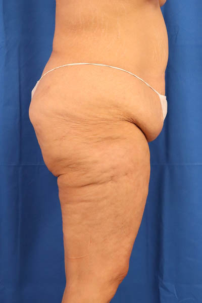Thigh Lift case #5532