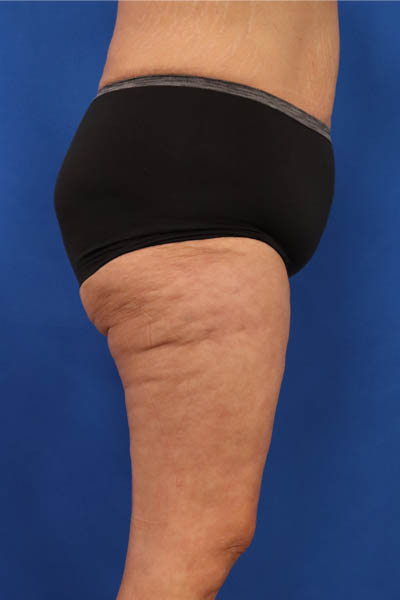 Thigh Lift case #5532