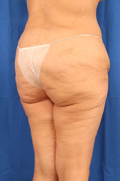 Thigh Lift case #5532
