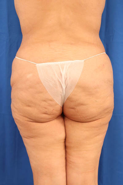 Thigh Lift case #5532