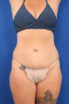 Abdominoplasty case #5521