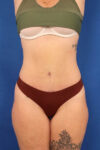 Abdominoplasty case #5521