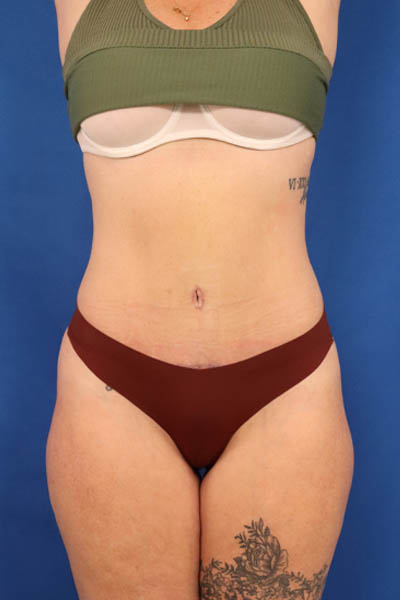 Abdominoplasty case #5521