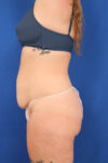 Abdominoplasty case #5521
