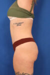 Abdominoplasty case #5521