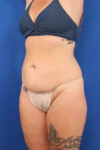 Abdominoplasty case #5521