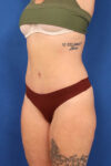 Abdominoplasty case #5521