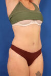 Abdominoplasty case #5521