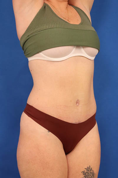 Abdominoplasty case #5521