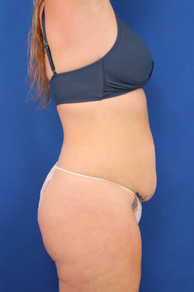 Abdominoplasty case #5521
