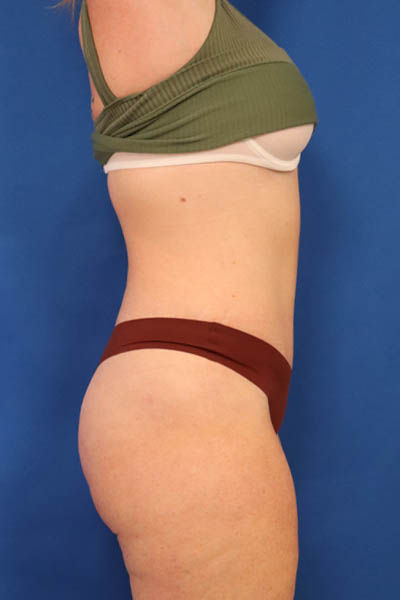Abdominoplasty case #5521