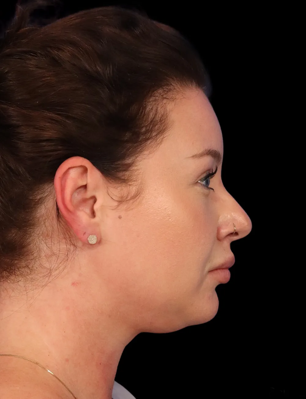 Neck Liposuction case #5213