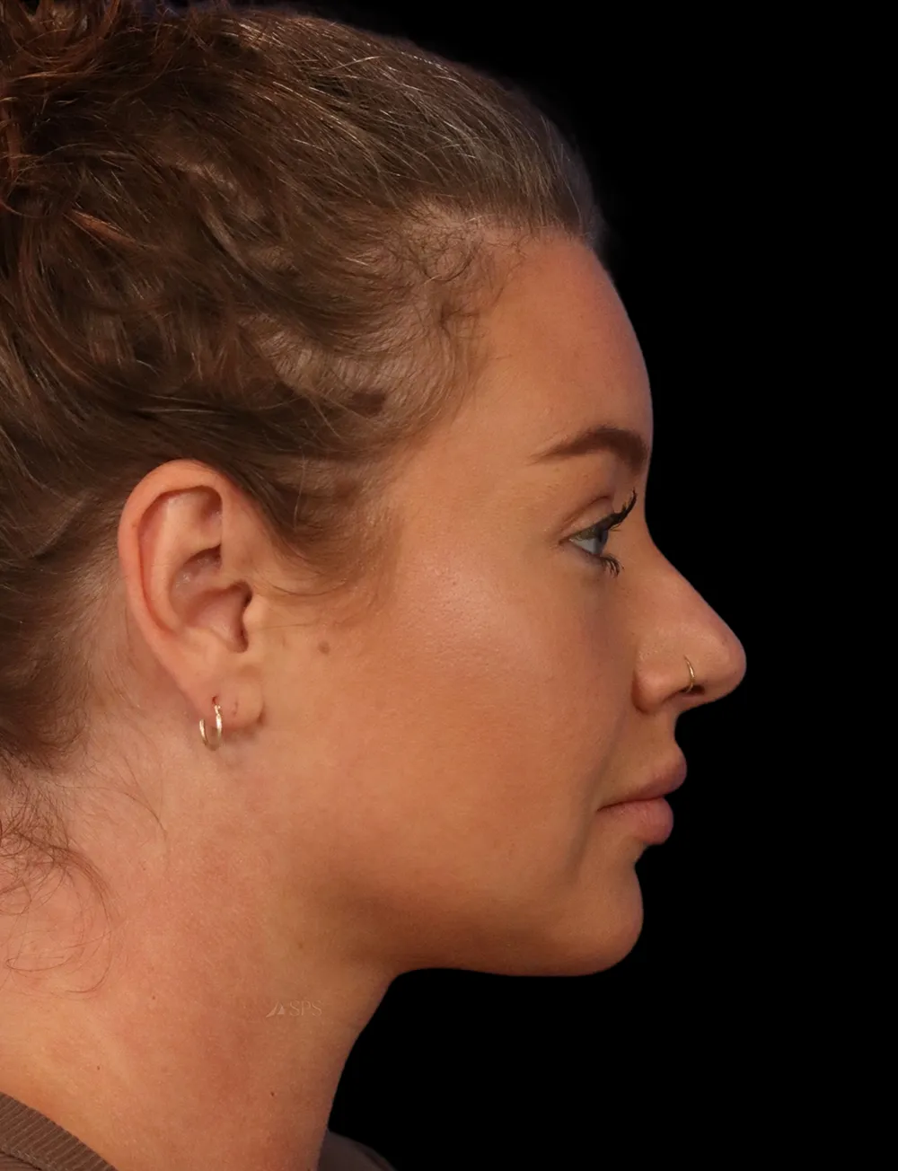 Neck Liposuction case #5213