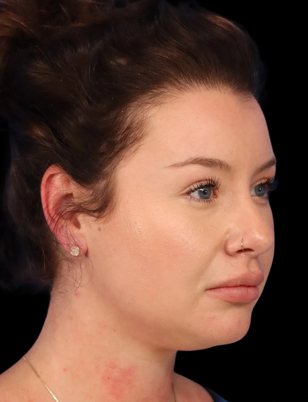 Neck Liposuction case #5213