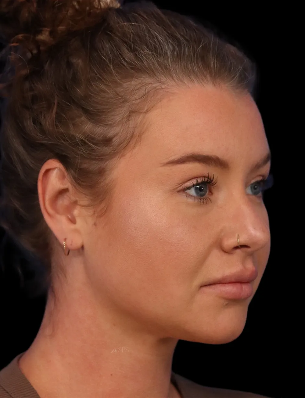 Neck Liposuction case #5213