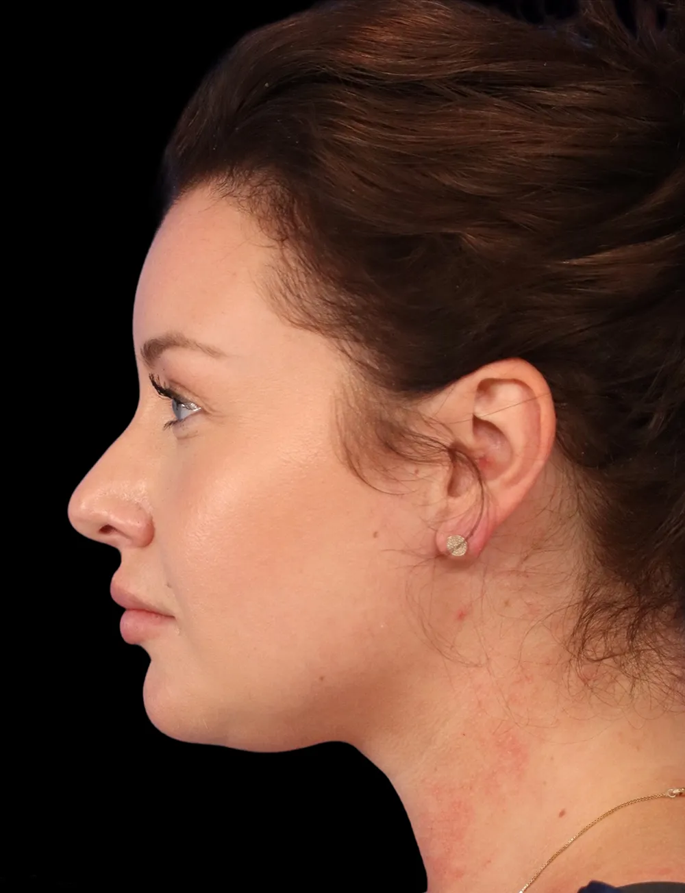 Neck Liposuction case #5213