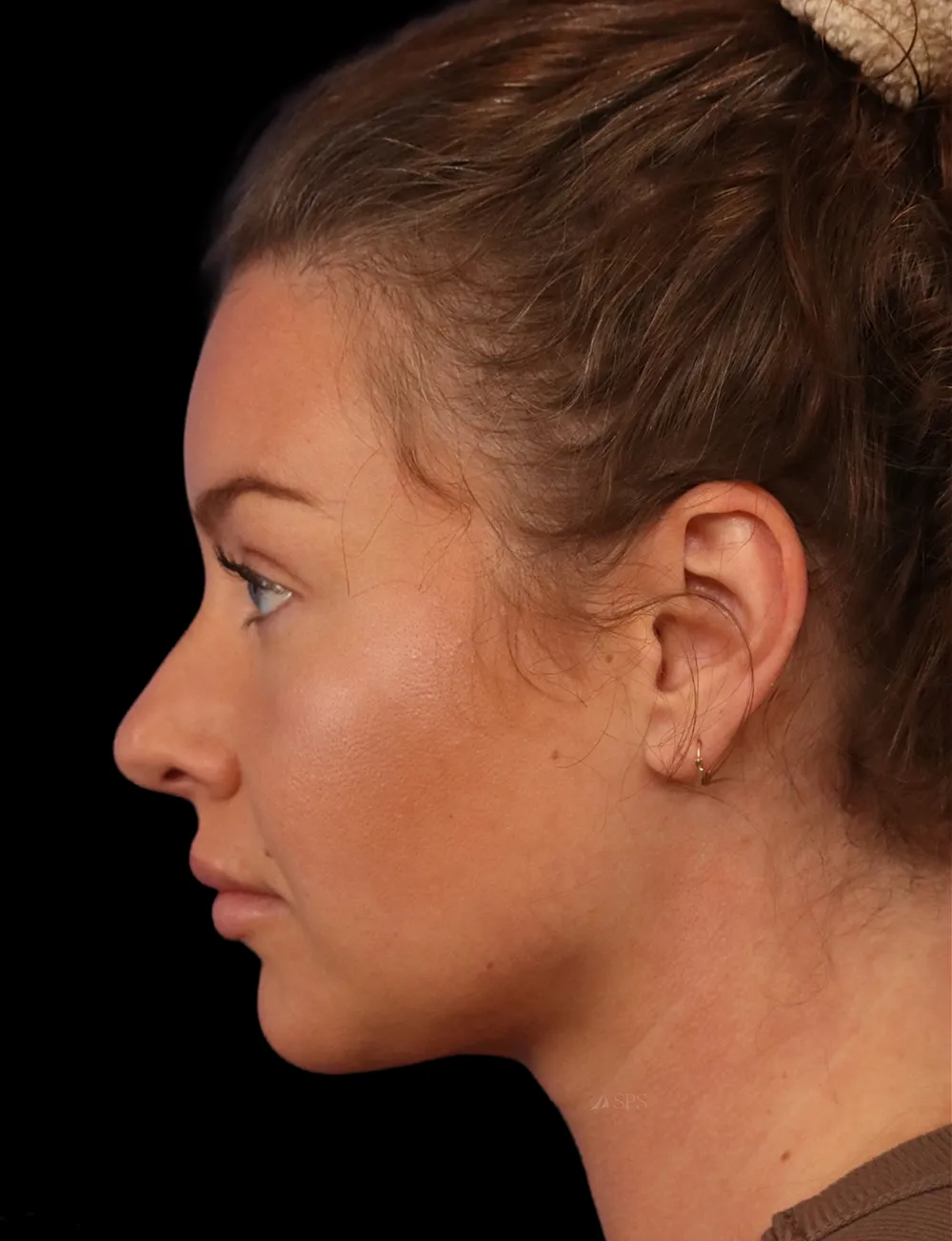 Neck Liposuction case #5213