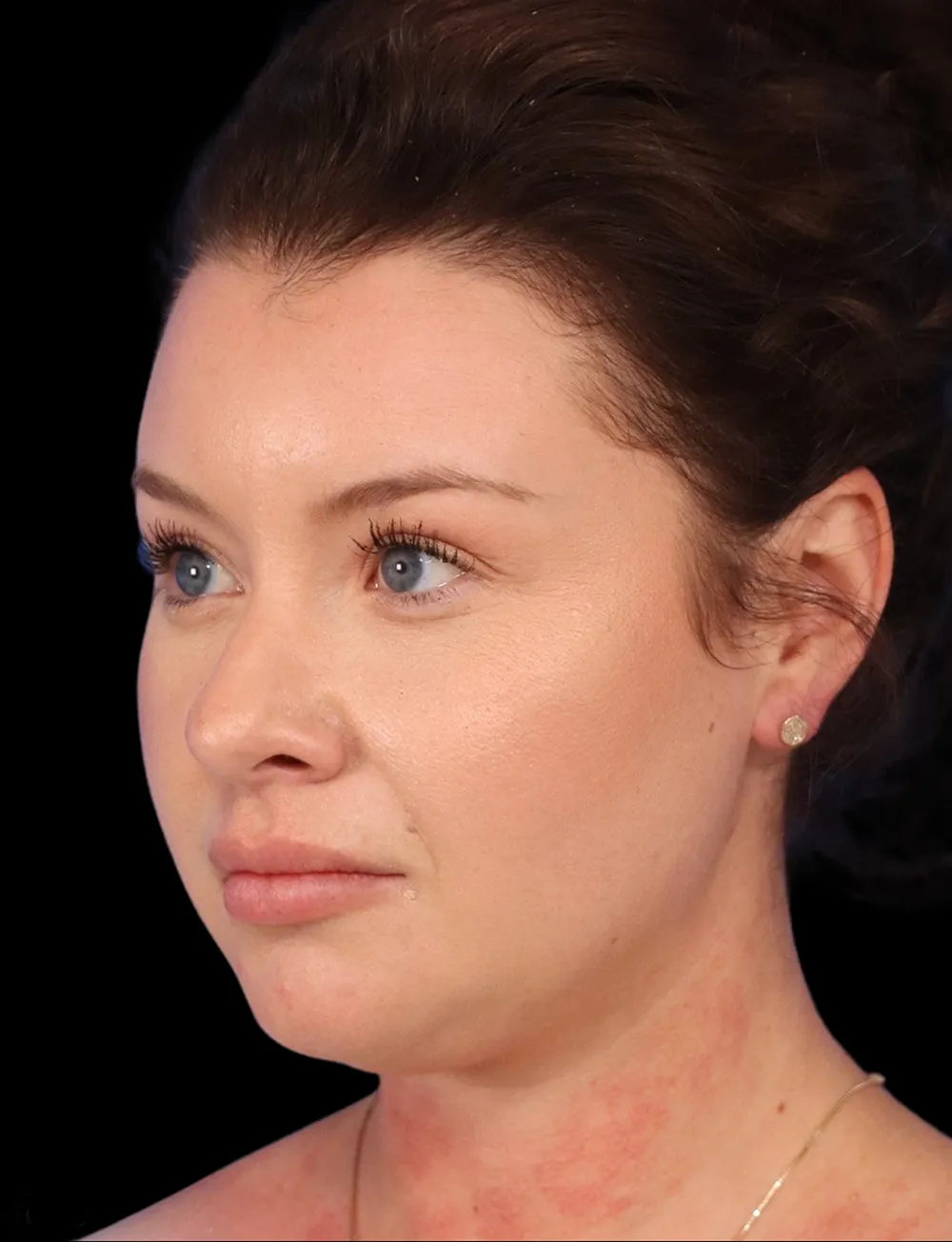 Neck Liposuction case #5213