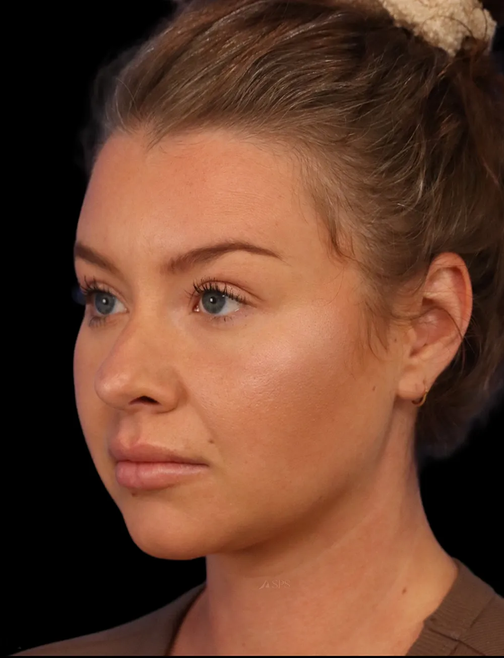 Neck Liposuction case #5213