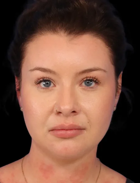 Neck Liposuction case #5213