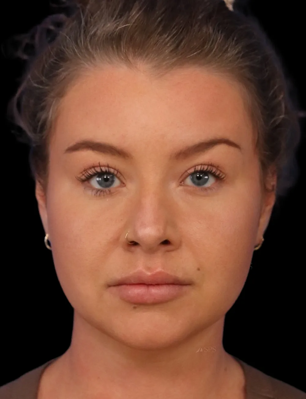 Neck Liposuction case #5213