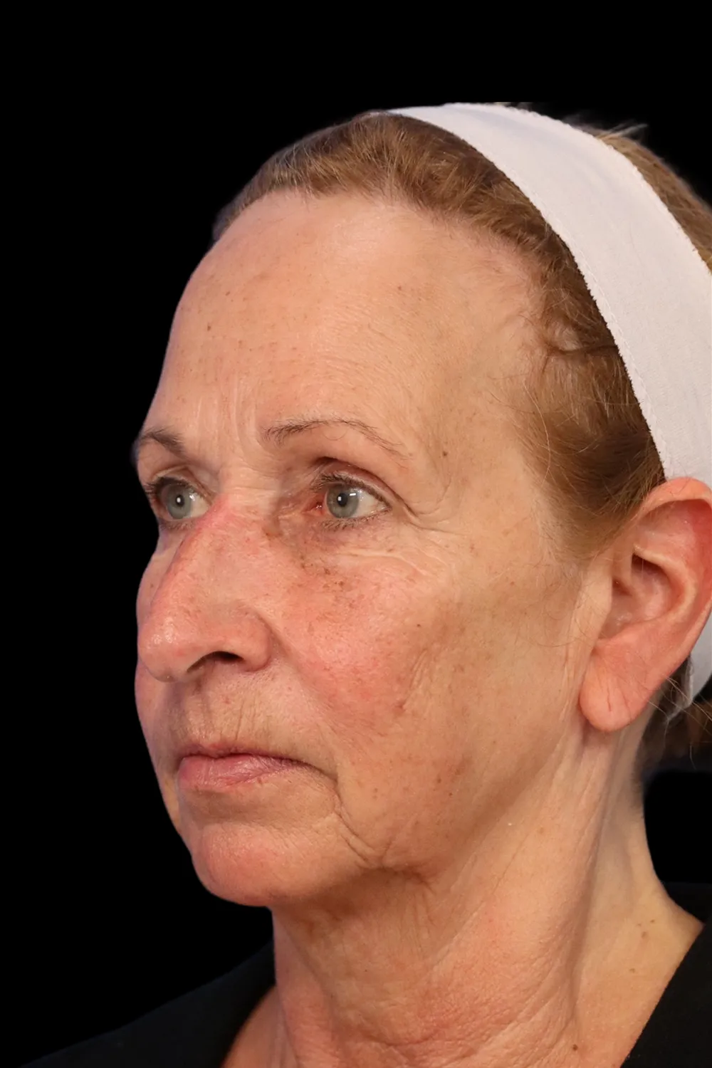 Rhinoplasty case #7912