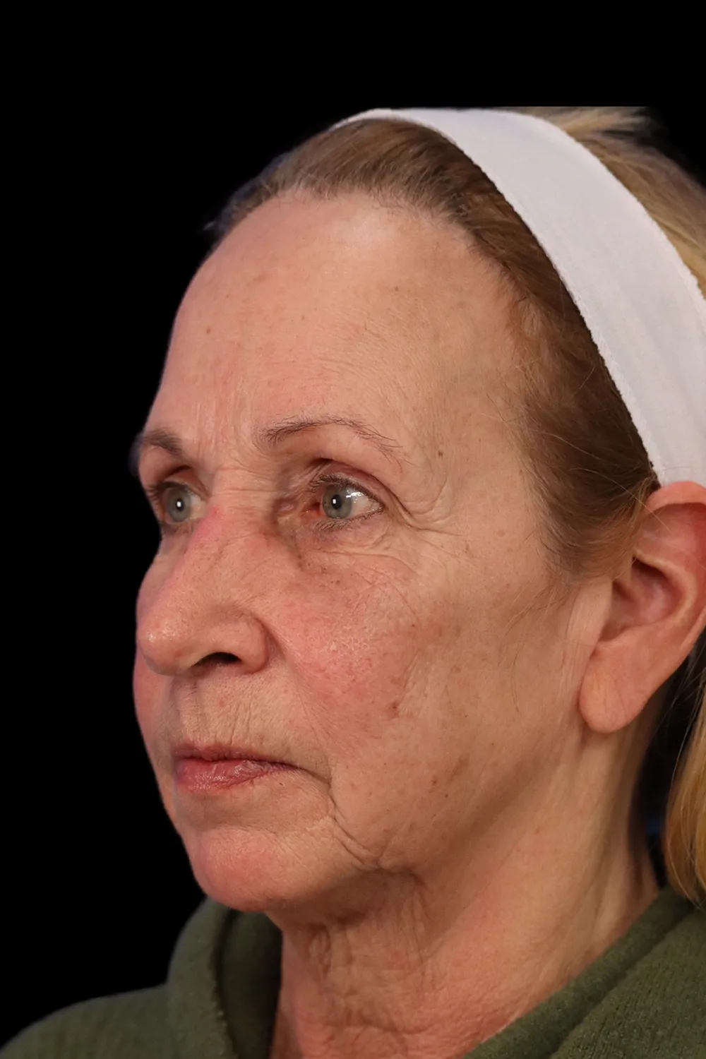 Rhinoplasty case #7912