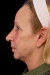 Rhinoplasty case #7912