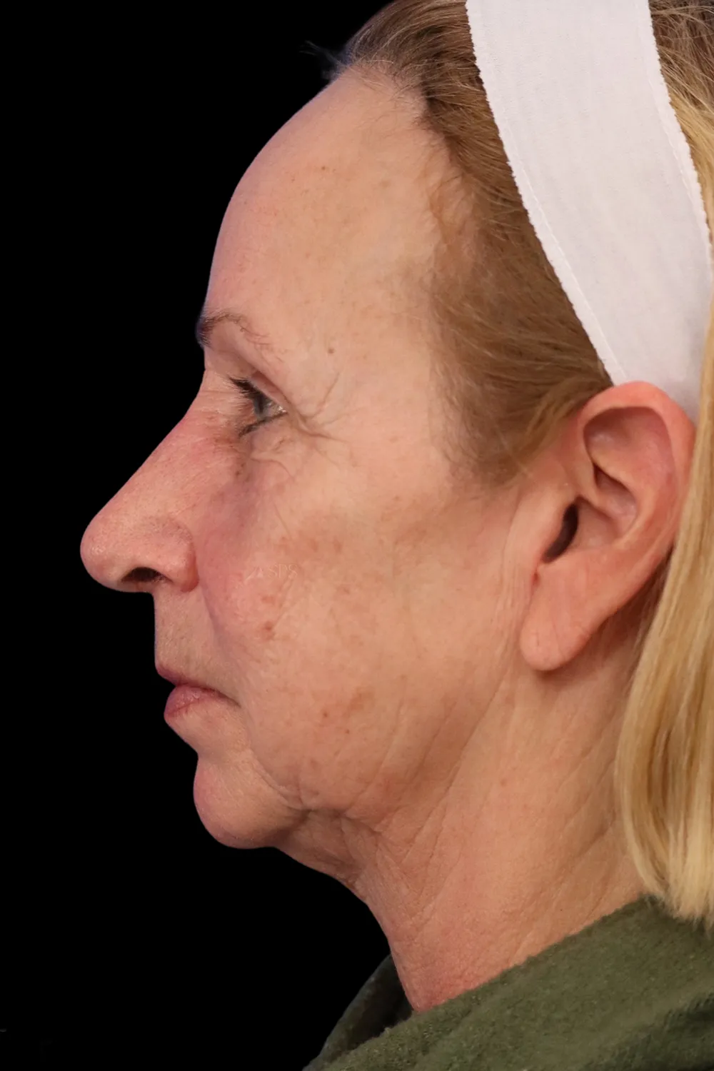 Rhinoplasty case #7912