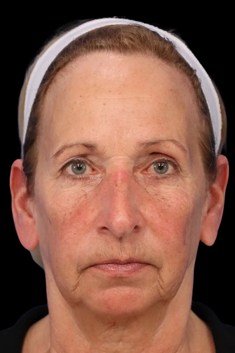 Rhinoplasty case #7912