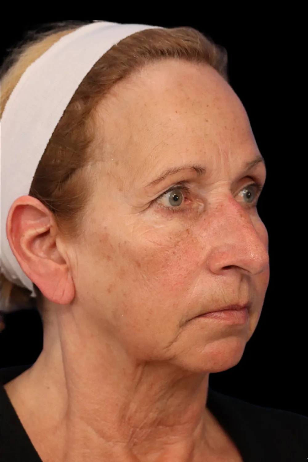 Rhinoplasty case #7912