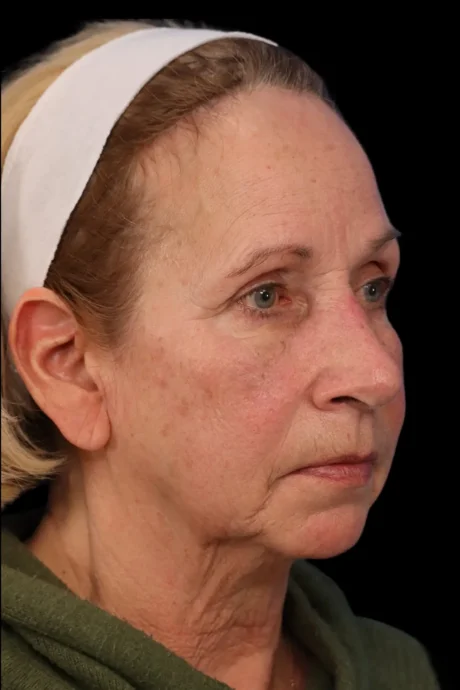 Rhinoplasty case #7912