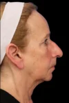 Rhinoplasty case #7912