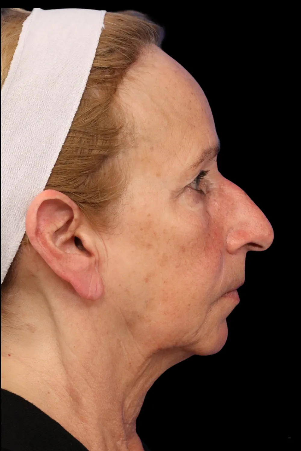 Rhinoplasty case #7912