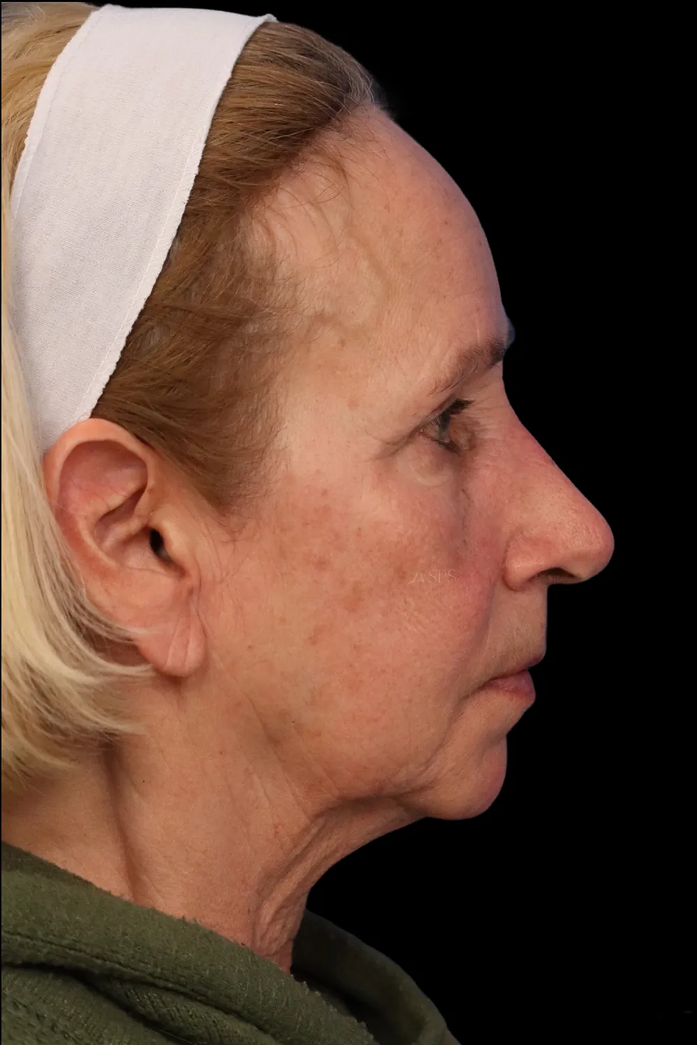 Rhinoplasty case #7912