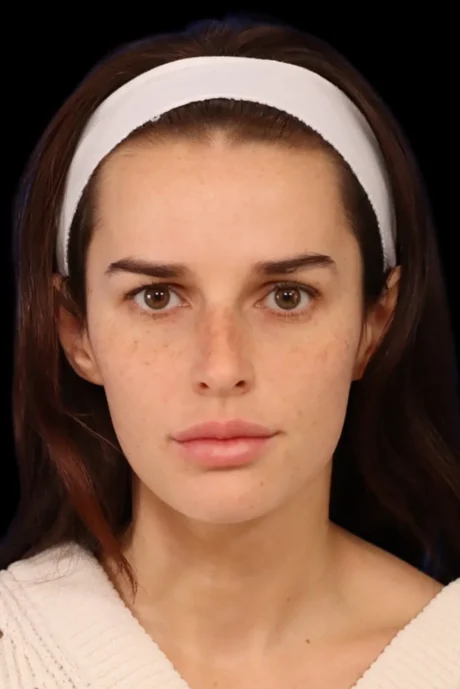 Rhinoplasty case #7923