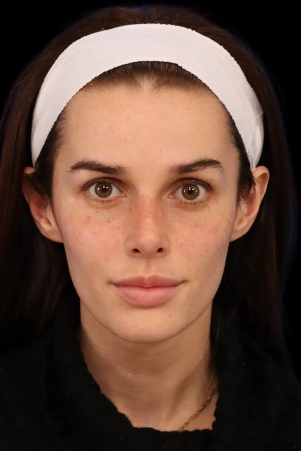 Rhinoplasty case #7923