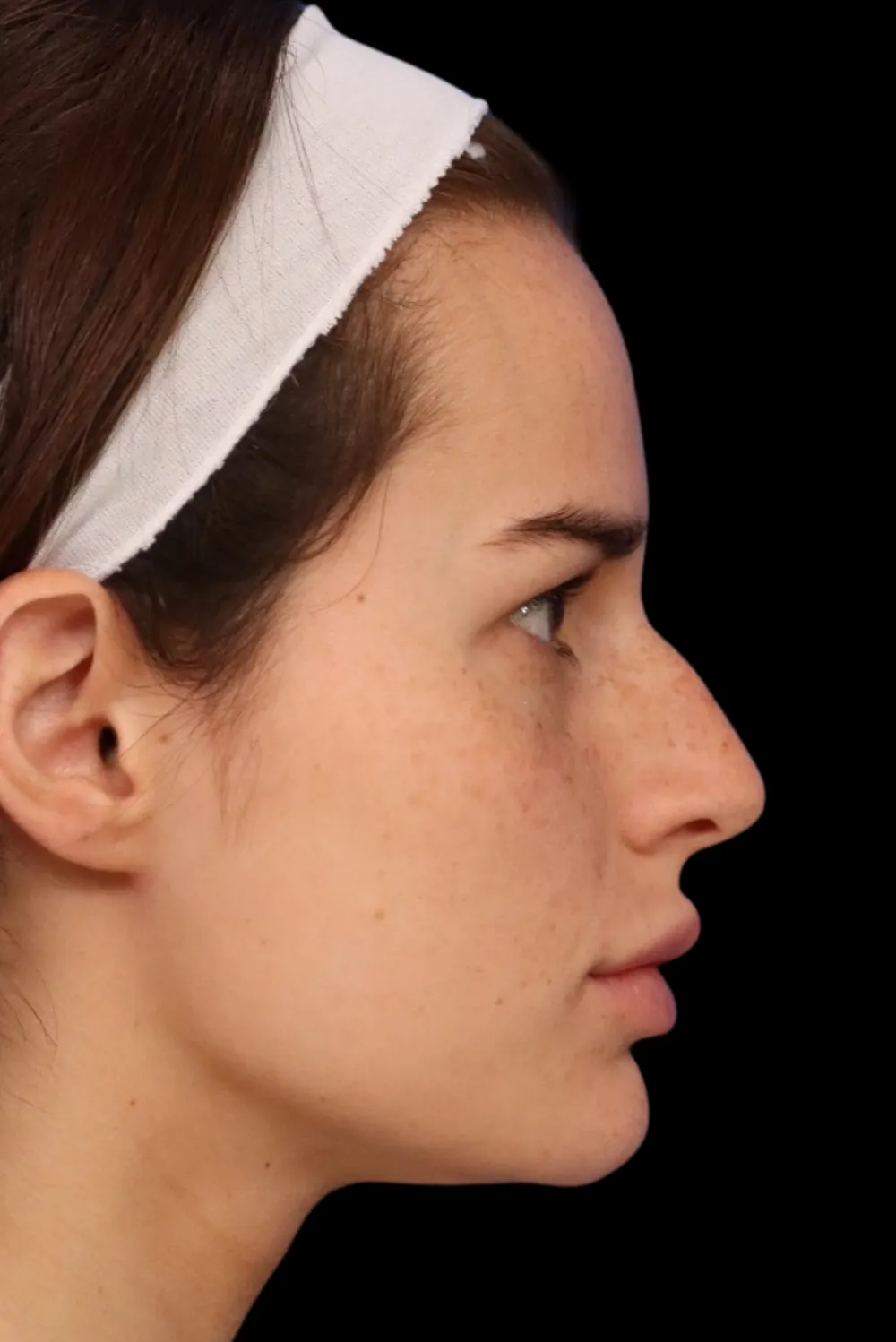 Rhinoplasty case #7923