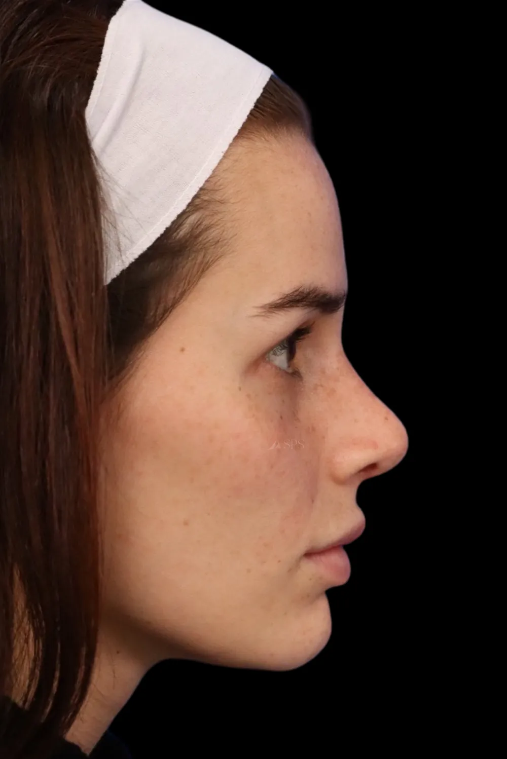 Rhinoplasty case #7923