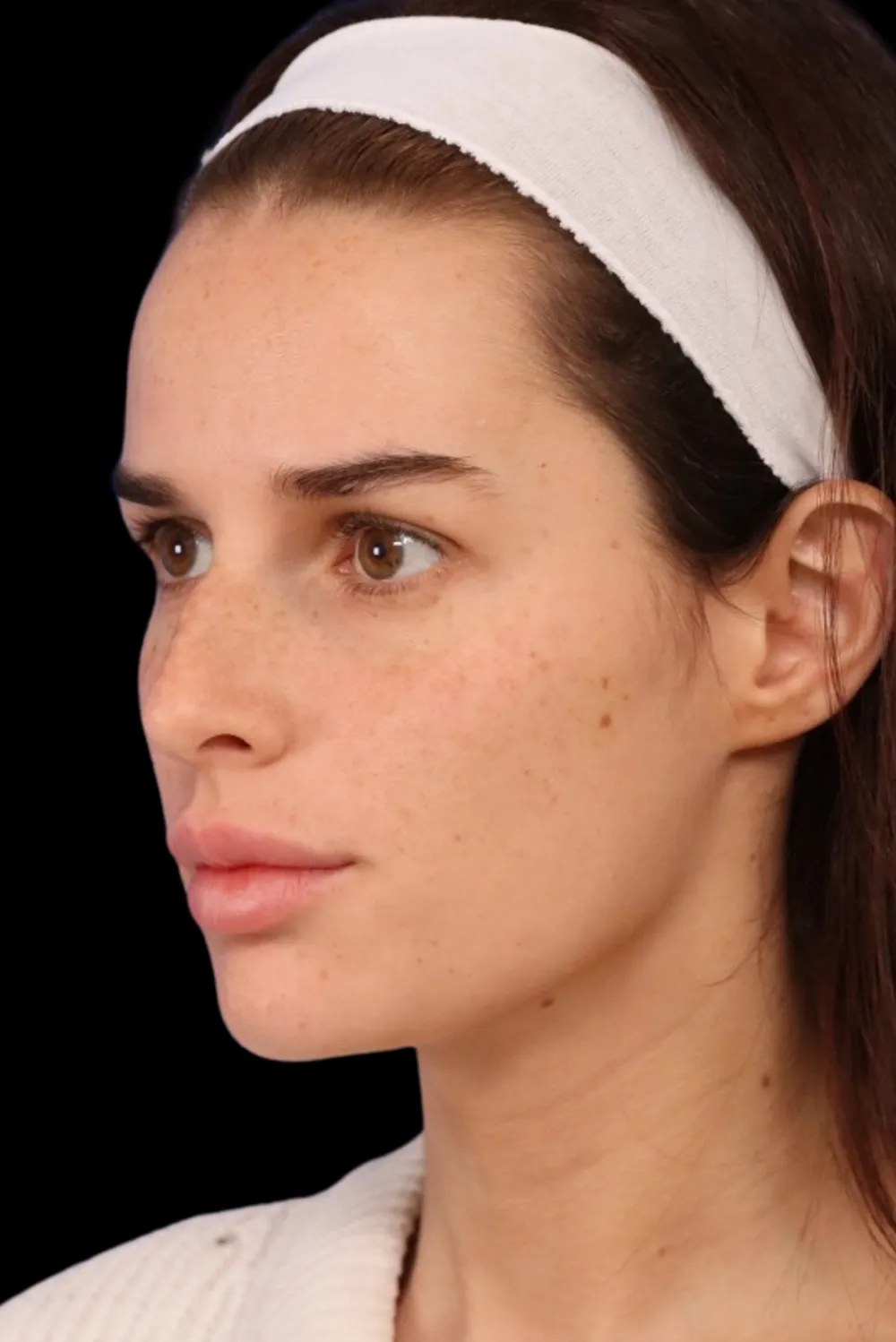 Rhinoplasty case #7923