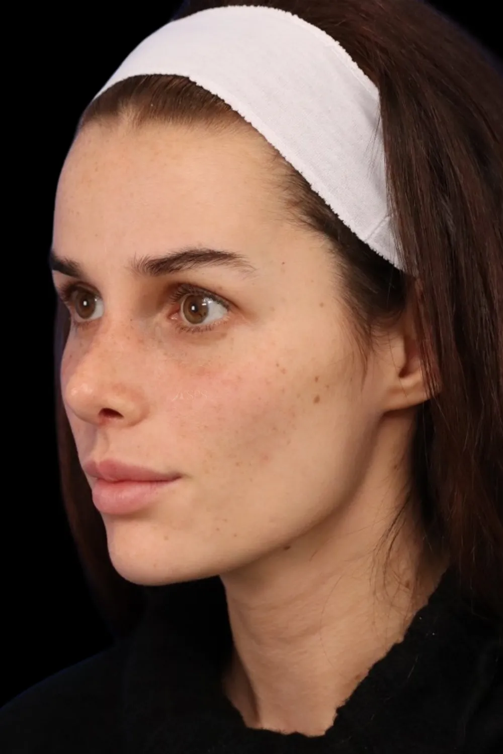 Rhinoplasty case #7923