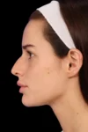 Rhinoplasty case #7923