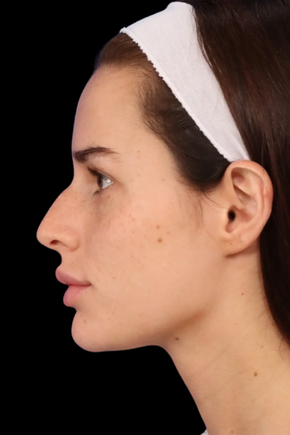 Rhinoplasty case #7923