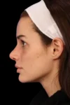 Rhinoplasty case #7923